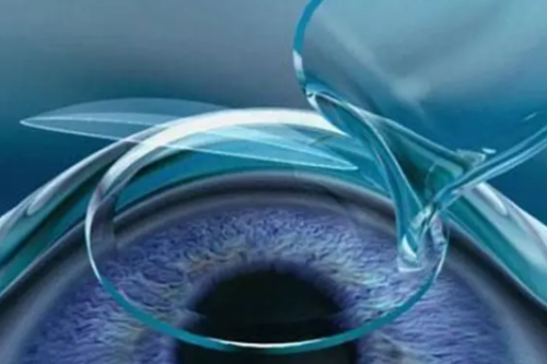 近视手术概念图