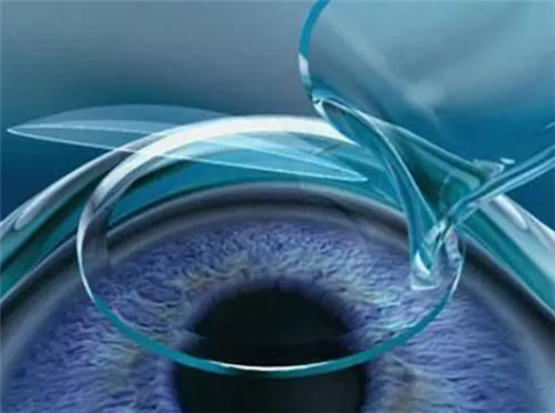 飞秒手术模拟图