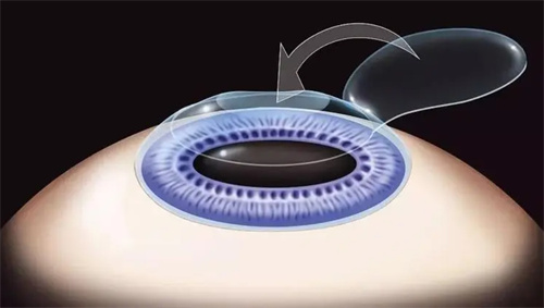 角膜切割动画图