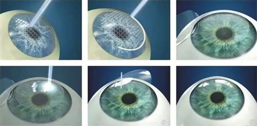 全飞秒手术过程图