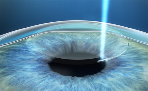 飞秒激光动画图