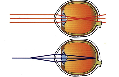 近视眼和正常眼对比图
