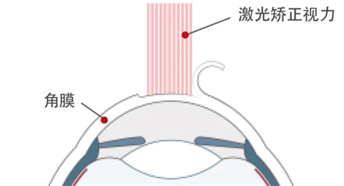 激光矫正视力原理图