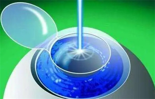 角膜切割动画图